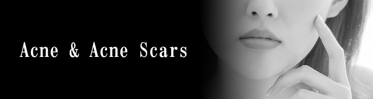 Acne & Acne Scars