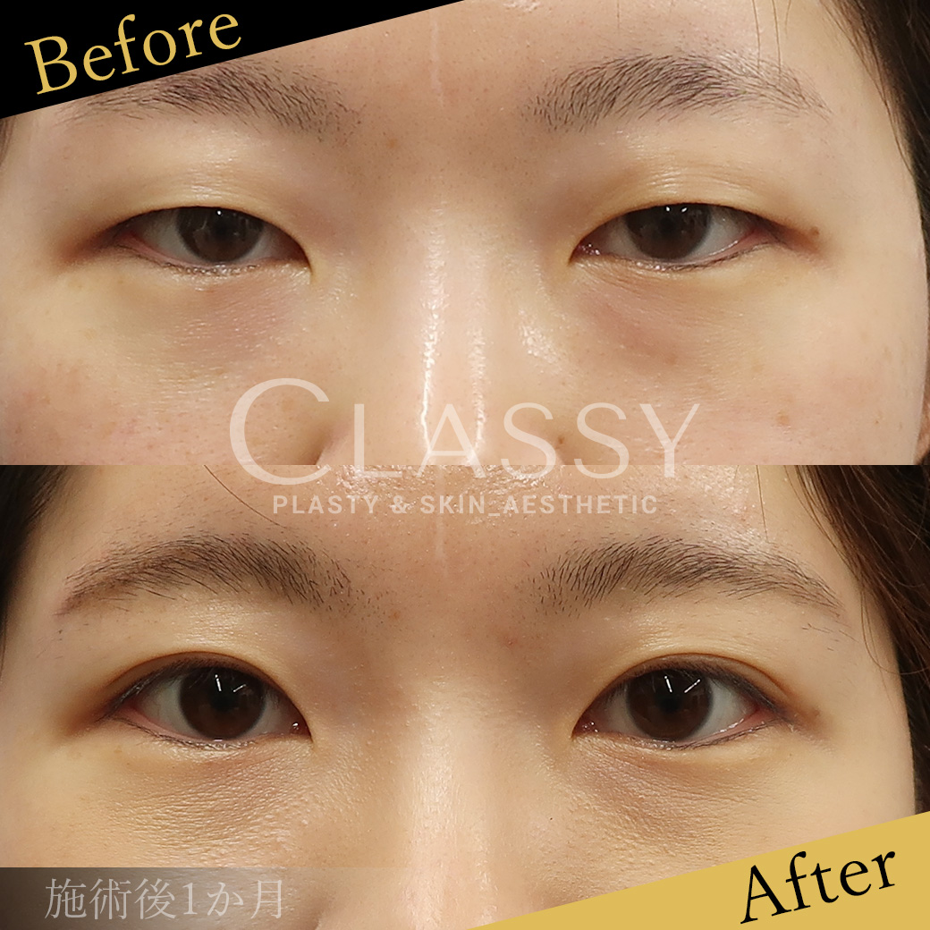 埋没法二重術ハイグレード法_施術後1か月 | CLASSY仙台美容外科・美容皮膚科