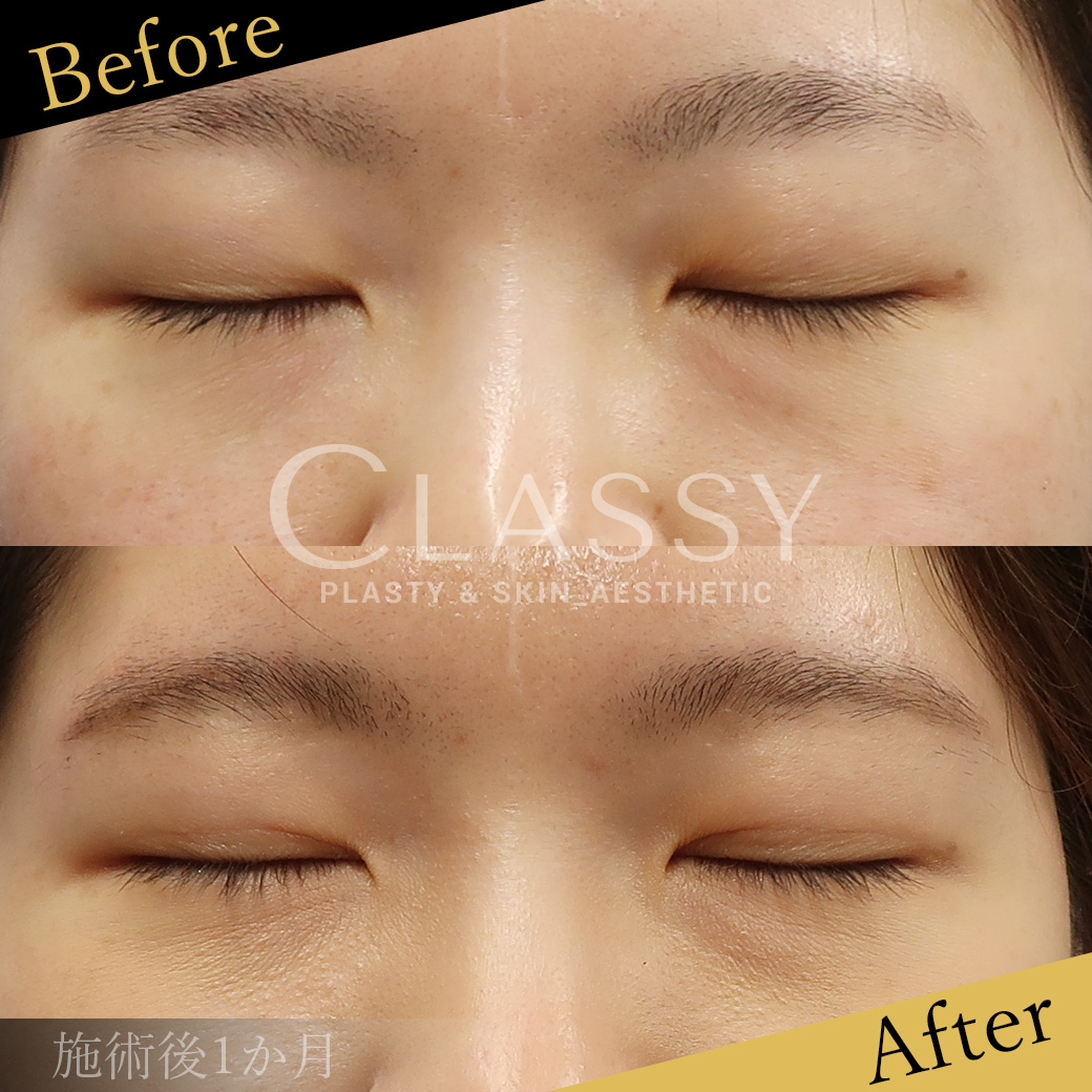 埋没法二重術ハイグレード法_施術後1か月 | CLASSY仙台美容外科・美容皮膚科
