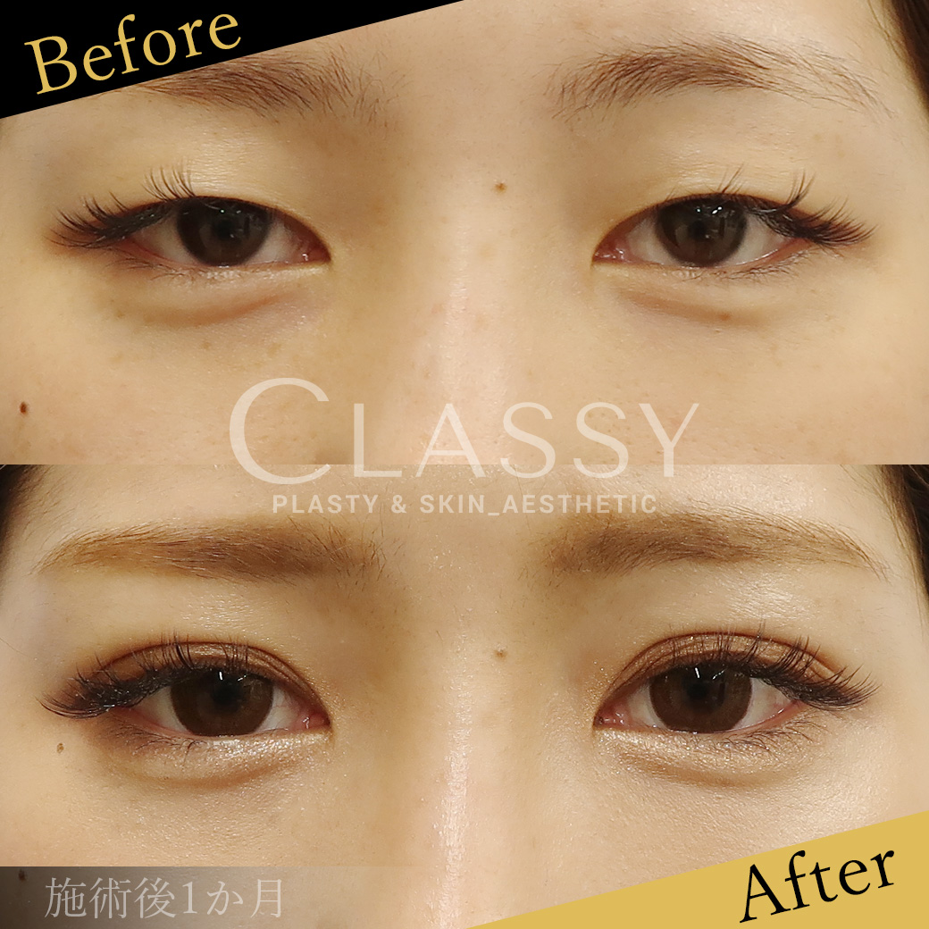 埋没法二重術エターナルライナー法_施術後1か月 | CLASSY仙台美容外科・美容皮膚科