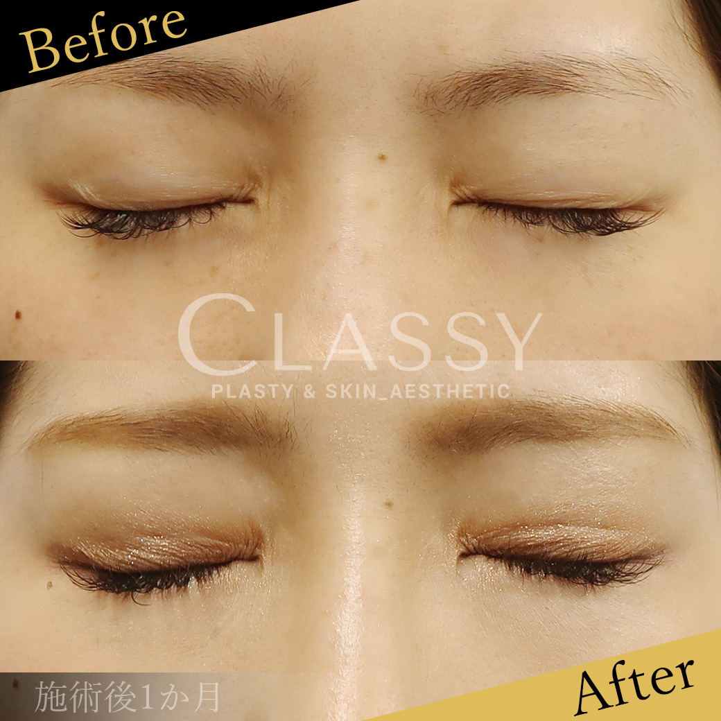 埋没法二重術エターナルライナー法_施術後1か月 | CLASSY仙台美容外科・美容皮膚科