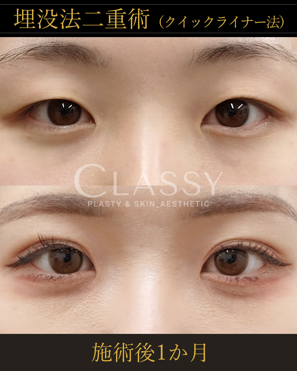埋没法二重術クイックライナー法_施術後1か月 | CLASSY仙台美容外科・美容皮膚科