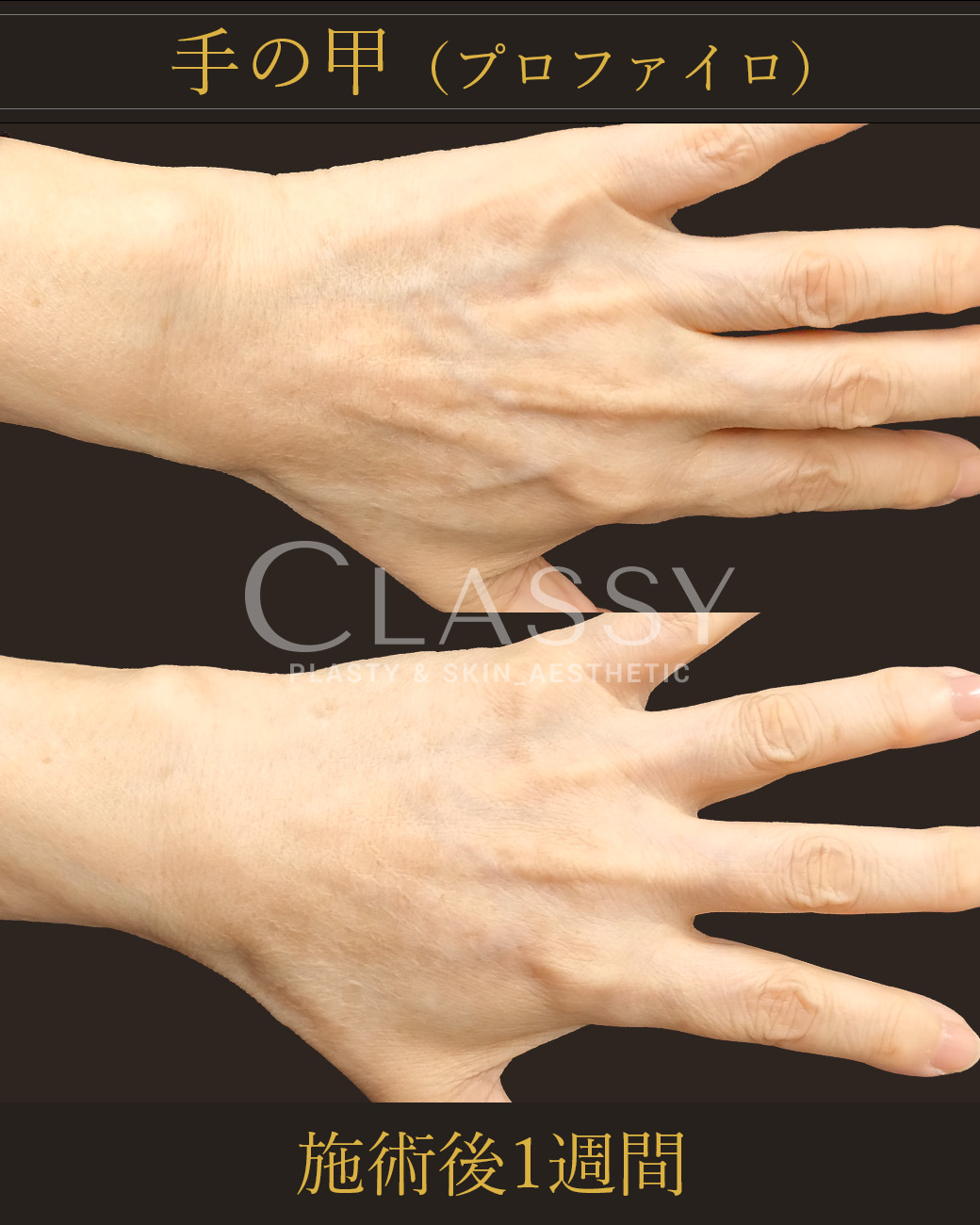 プロファイロ_施術後1週間 | CLASSY仙台美容外科・美容皮膚科