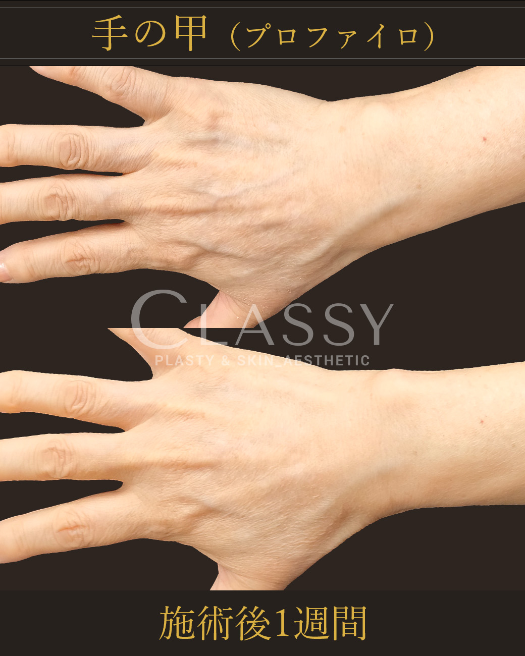 プロファイロ_施術後1週間 | CLASSY仙台美容外科・美容皮膚科