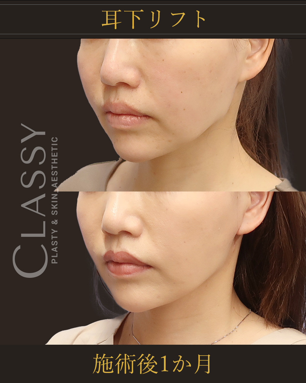 耳下リフト1_施術後1か月 | CLASSY仙台美容外科・美容皮膚科