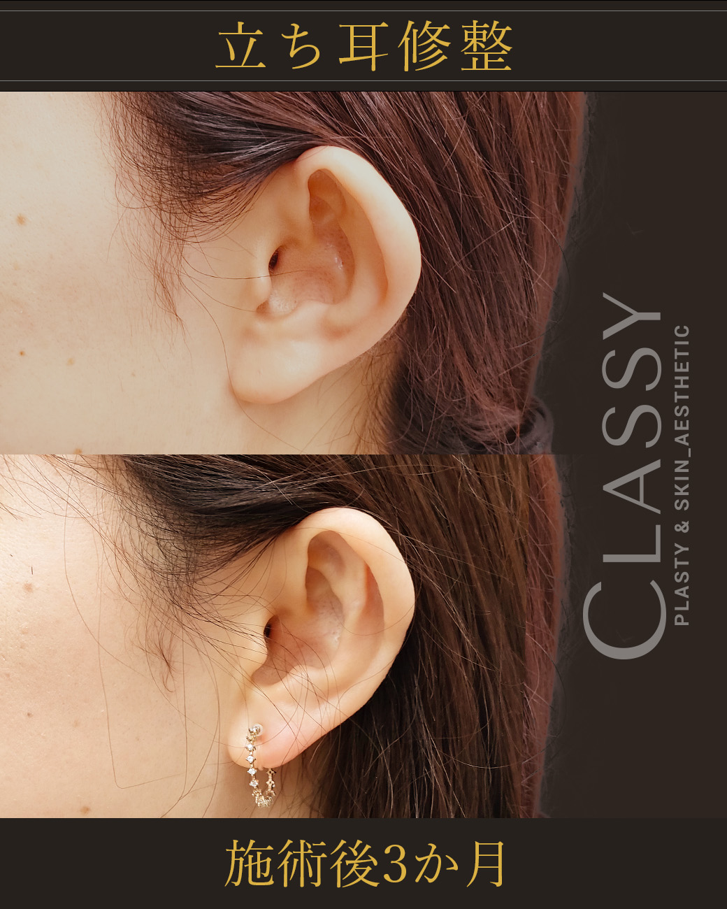 立ち耳修整_施術後3か月 | CLASSY仙台美容外科・美容皮膚科
