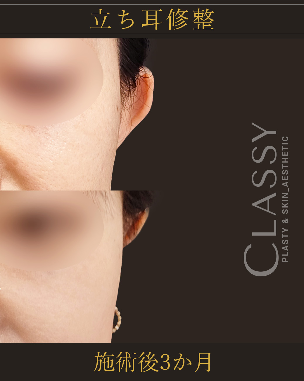 立ち耳修整_施術後3か月_2 | CLASSY仙台美容外科・美容皮膚科